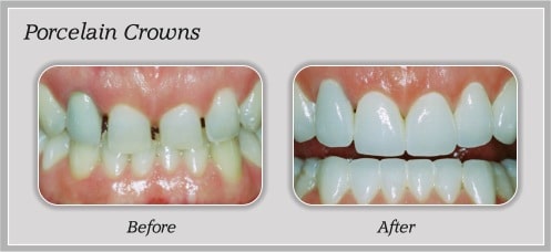 Dental Crowns & Bridges in Flower Mound, TX Brite Smiles Dentistry dentist in Flower Mound, Tx Dr. Deepika Salguti DMD