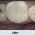 Inlays and Onlays Brite Smiles Dentistry dentist in Flower Mound, Tx Dr. Deepika Salguti DMD