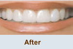 Veneers and Laminates Brite Smiles Dentistry dentist in Flower Mound, Tx Dr. Deepika Salguti DMD
