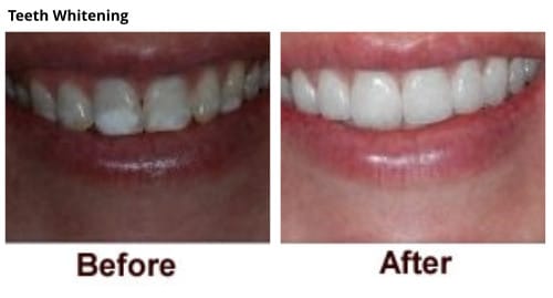 Cosmetic Dentistry Brite Smiles Dentistry dentist in Flower Mound, Tx Dr. Deepika Salguti DMD