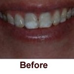Teeth Whitening in Flower Mound, TX Brite Smiles Dentistry dentist in Flower Mound, Tx Dr. Deepika Salguti DMD