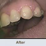 Composite Fillings Brite Smiles Dentistry dentist in Flower Mound, Tx Dr. Deepika Salguti DMD